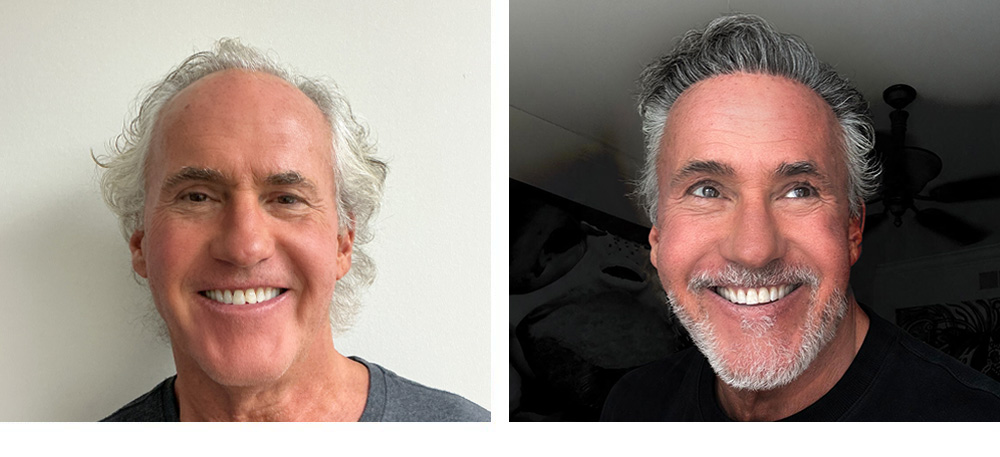 Hair Transplant Before and After