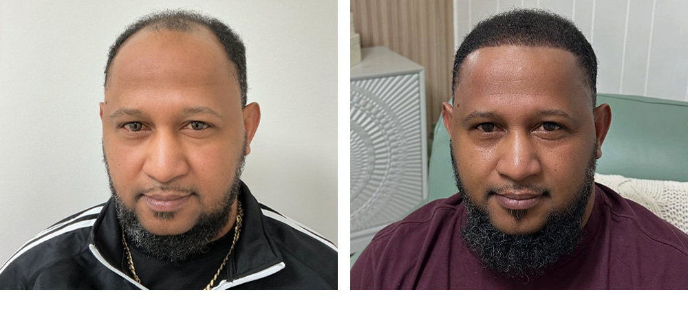 Hair Transplant Before and After