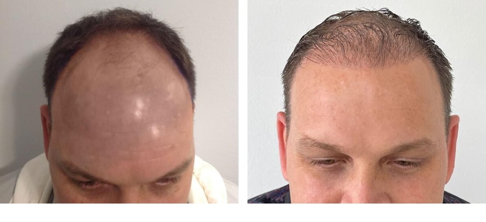 Hair Restoration Results Before and After