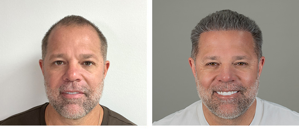 Hair Transplant Before and After