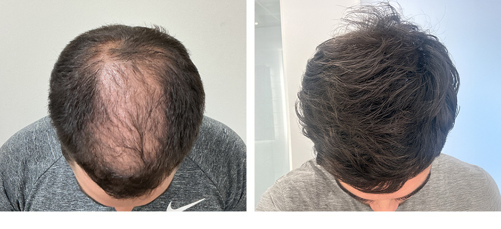 Hair Transplant Before and After