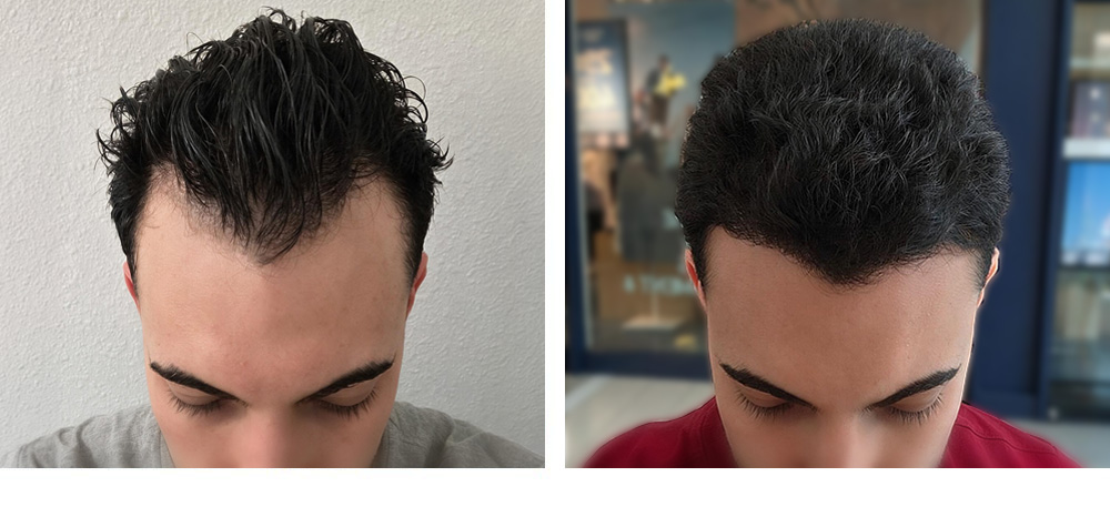 Hair Transplant before and after