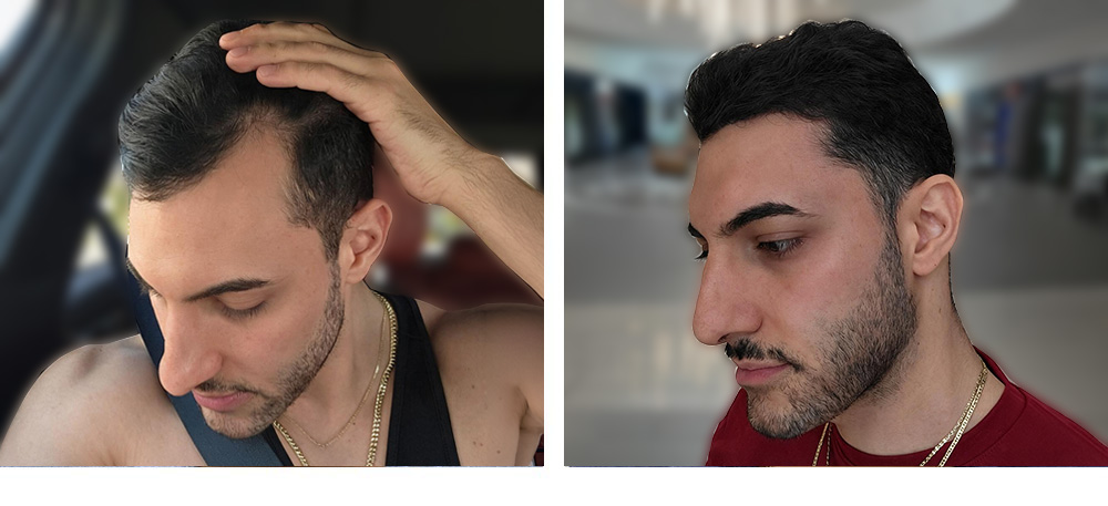 Hair Transplant before and after