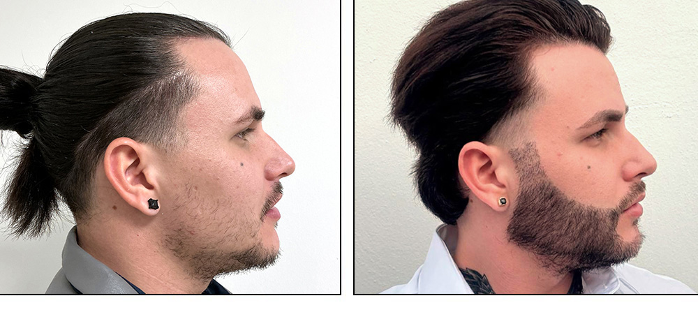 Beard Hair Transplant before and after