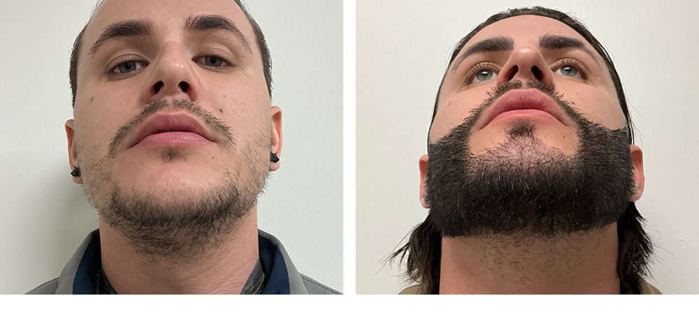 Beard Hair Transplant before and after