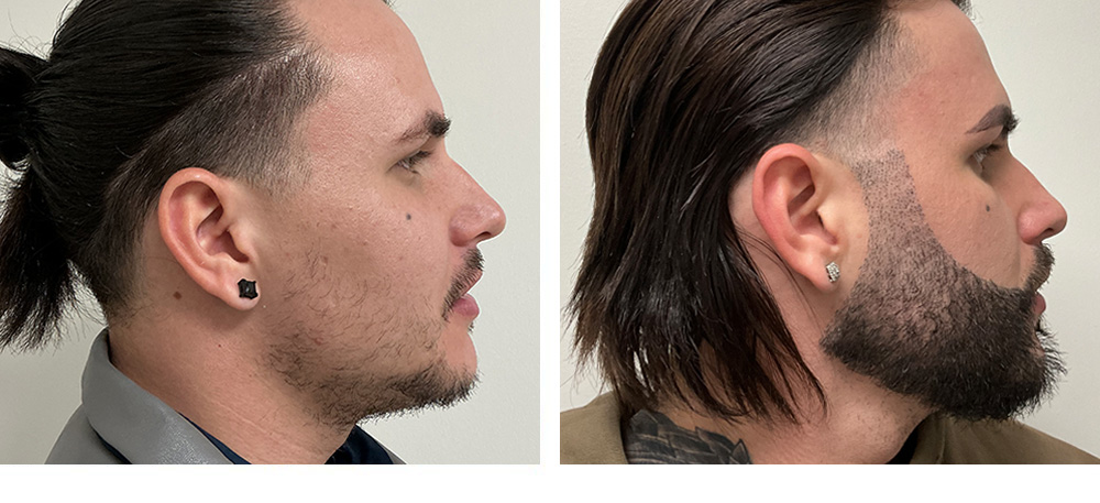 Beard Hair Transplant before and after
