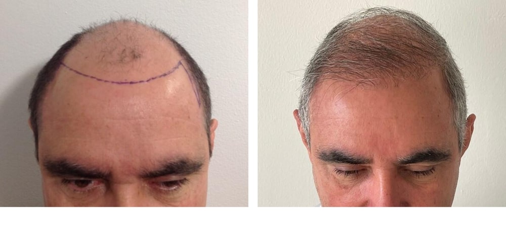 Hair Restoration Results Before and After
