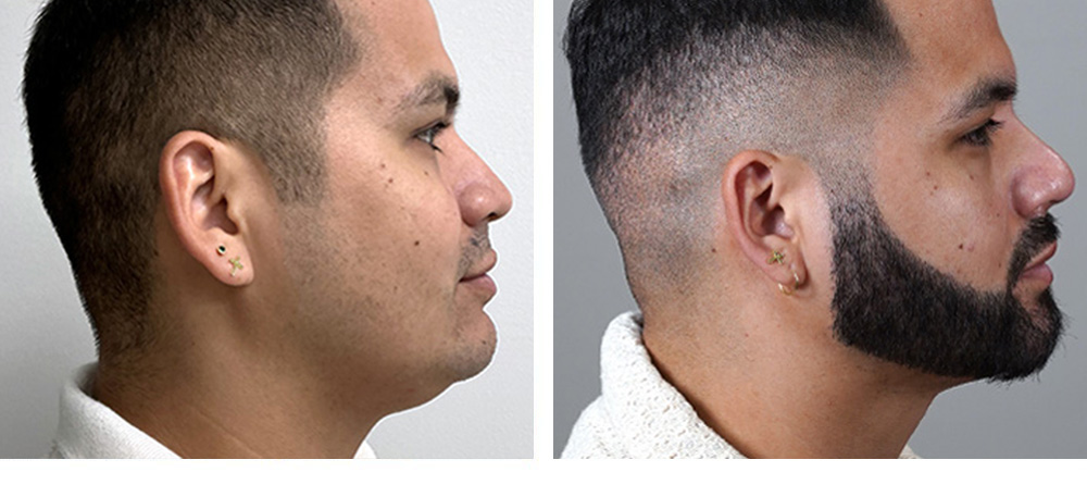Beard Hair Transplant Before and After