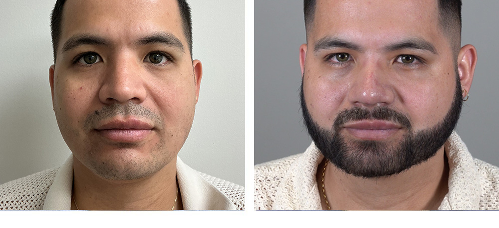 Beard Hair Transplant Before and After