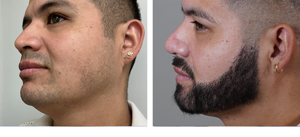 Beard Hair Transplant Before and After