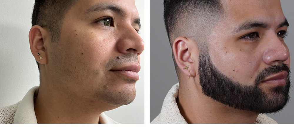 Beard Hair Transplant Before and After