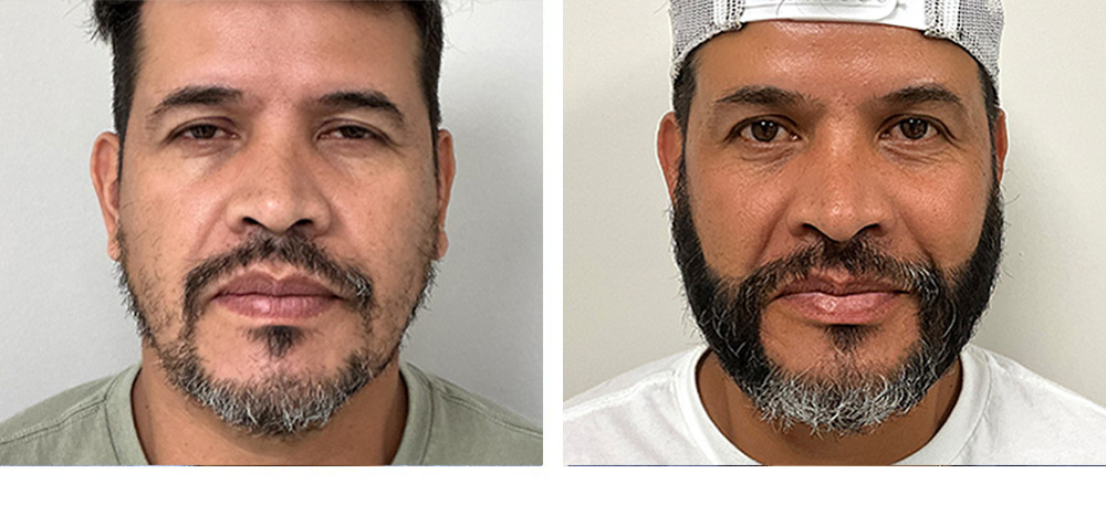 Hair Transplant Before and After