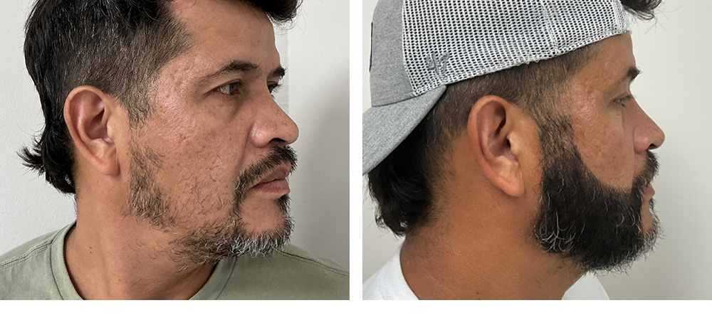 Hair Transplant Before and After