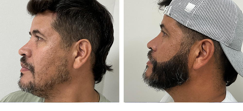 Hair Transplant Before and After
