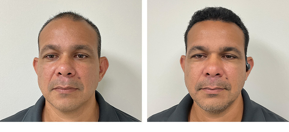 Hair Transplant Before and After