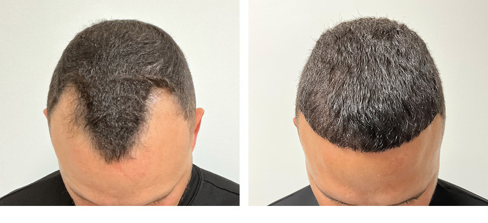 Hair Transplant Before and After