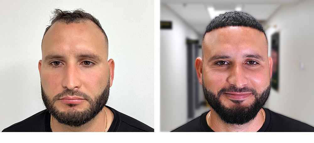 Hair Transplant Before and After