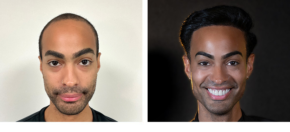 Hair Transplant before and after
