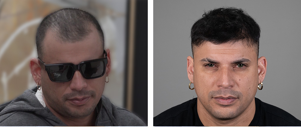Hair Transplant Before and After