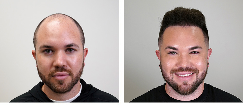 Hair Transplant Before and After