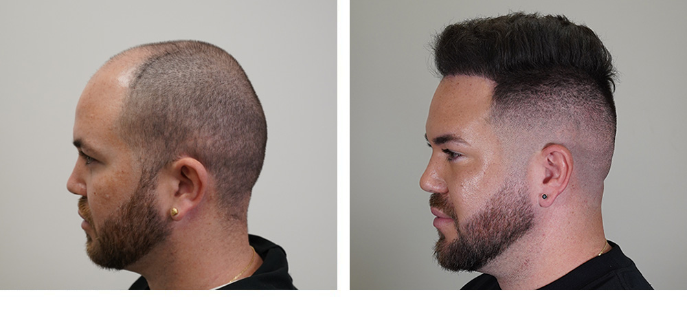 Hair Transplant Before and After