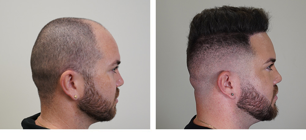 Hair Transplant Before and After
