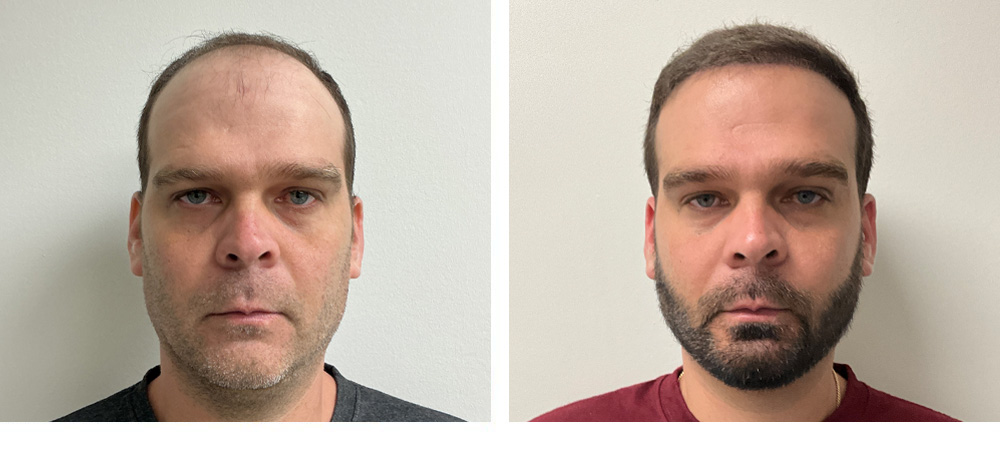 Hair Transplant Before and After