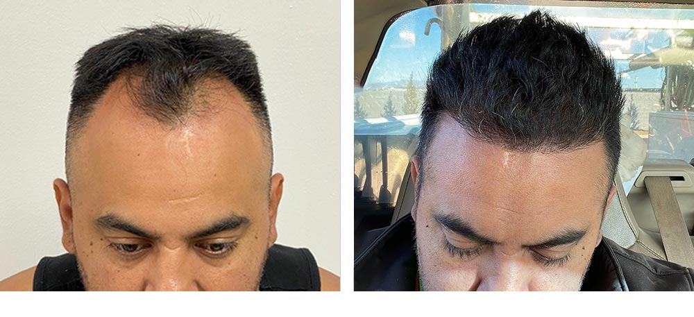 Hair Restoration Results Before and After