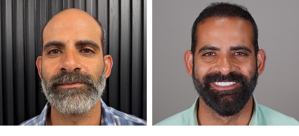 Hair Transplant Before and After