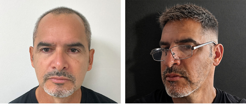 Hair Transplant Before and After