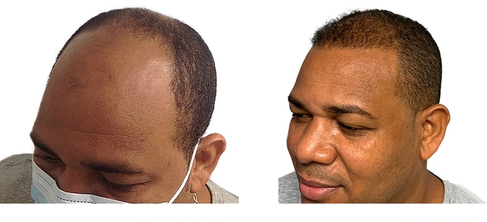Hair Restoration Results Before and After