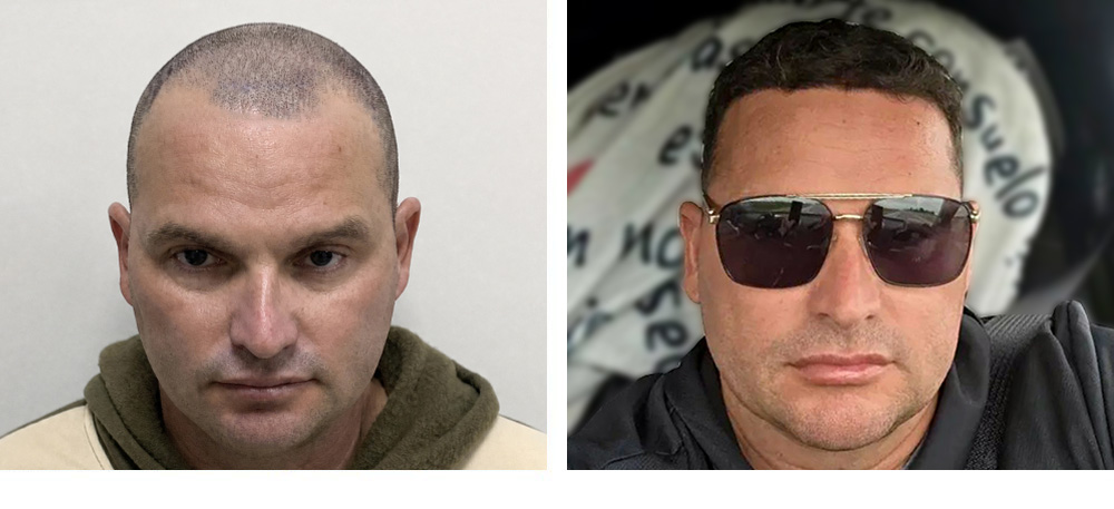 Hair Transplant Before and After