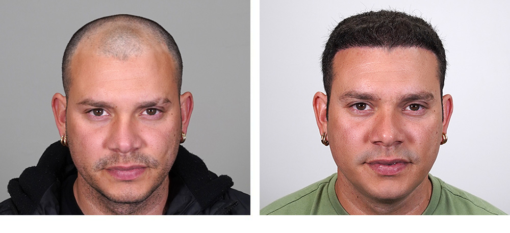 Hair Transplant before and after