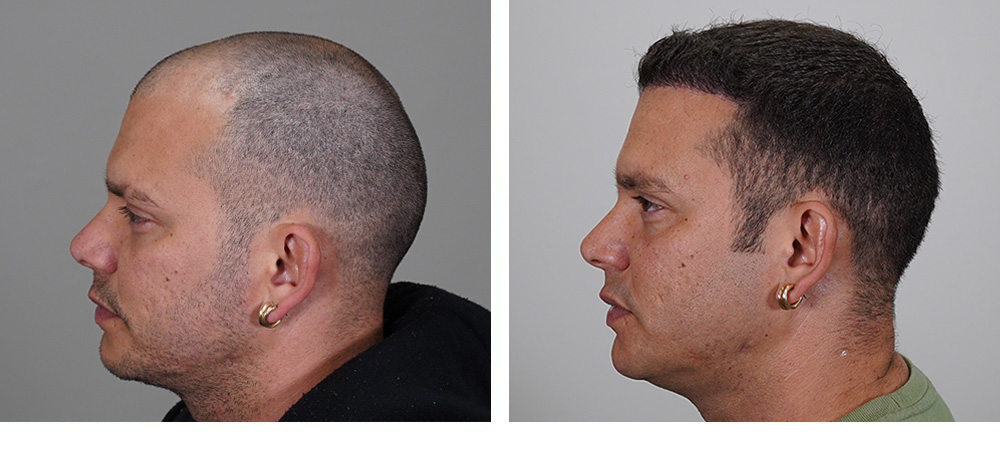 Hair Transplant before and after