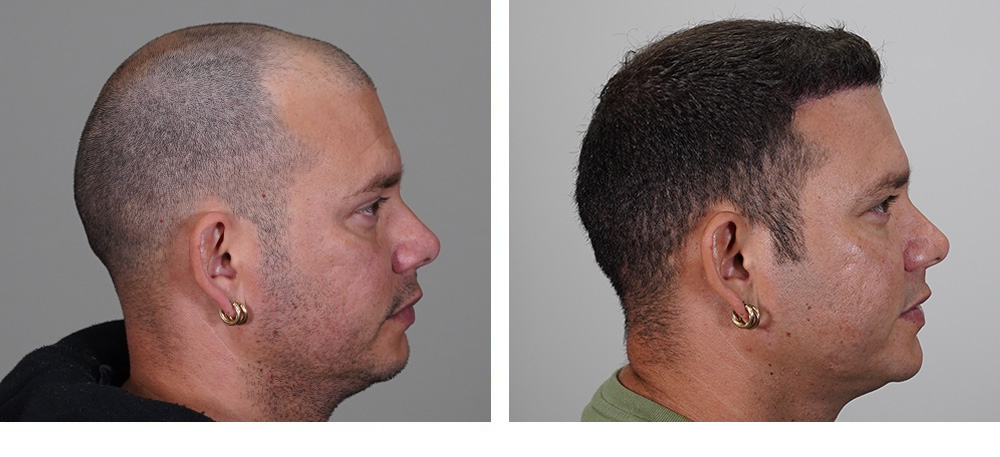 Hair Transplant before and after