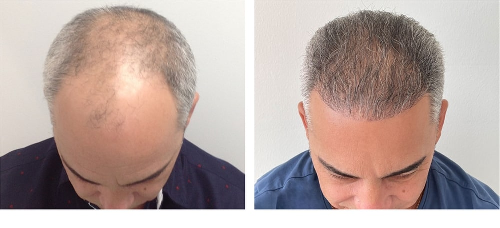 Hair Restoration Results Before and After
