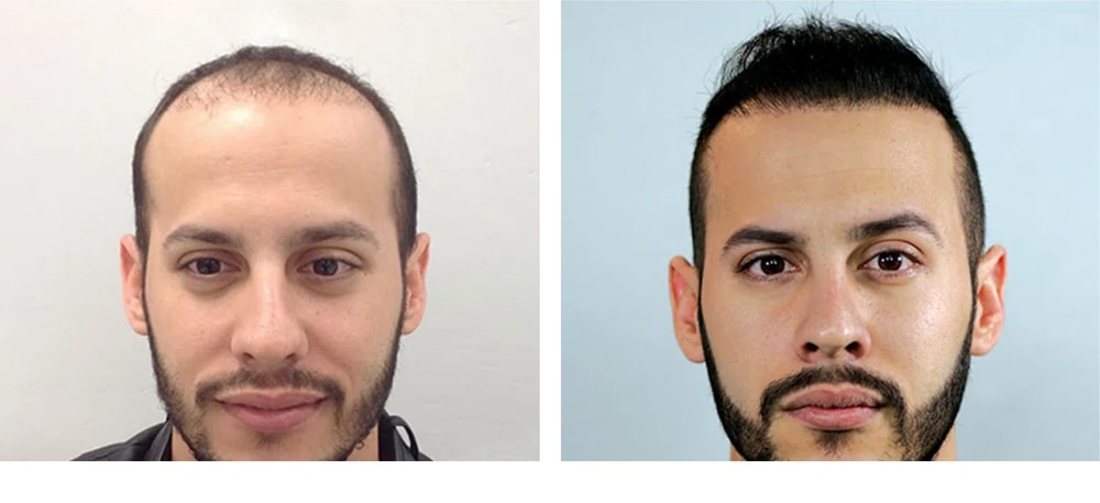 Hair Restoration Results Before and After
