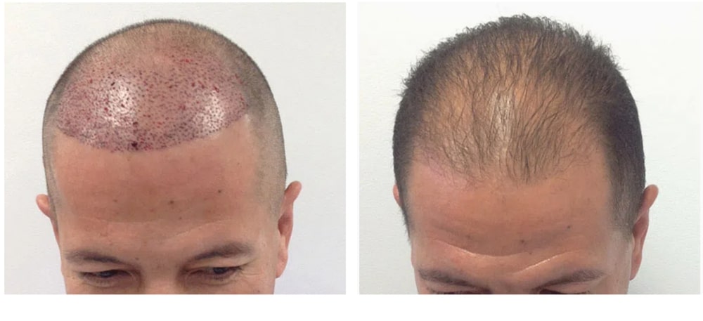 Hair Restoration Results Before and After