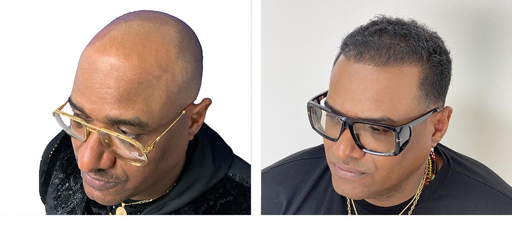 Hair Restoration Results Before and After