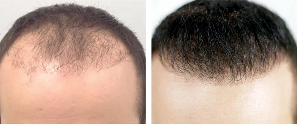 Hair Restoration Results Before and After