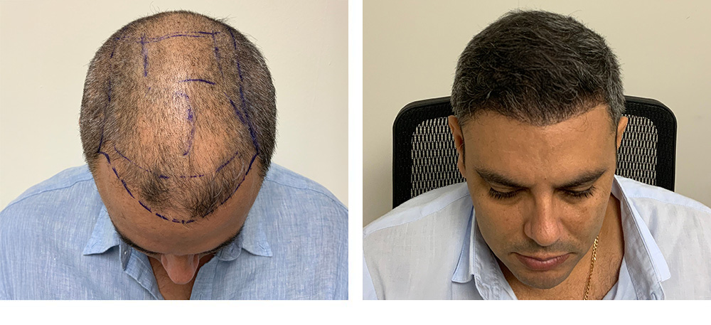 Hair Restoration Results Before and After