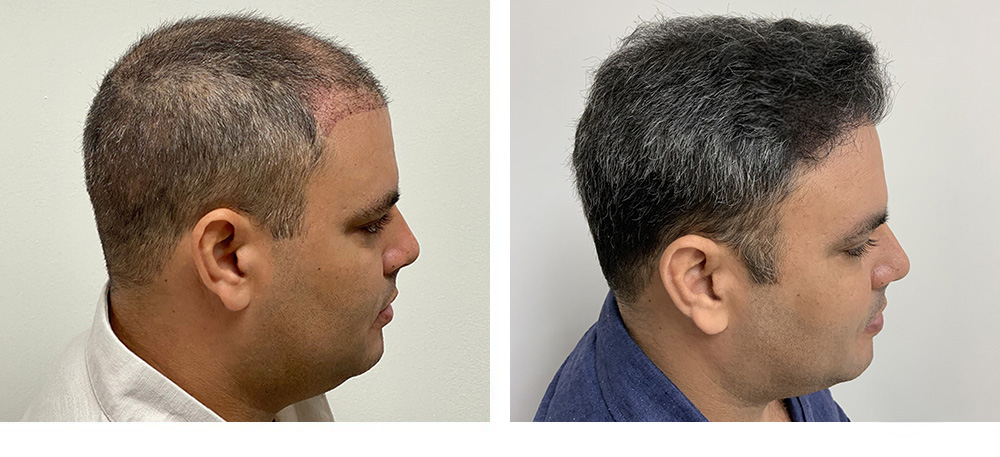 Hair Restoration Results Before and After