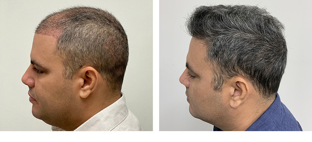 Hair Restoration Results Before and After