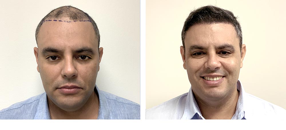 Hair Restoration Results Before and After