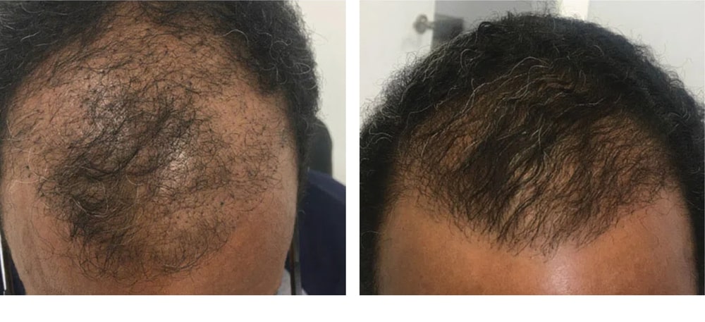 Hair Restoration Results Before and After