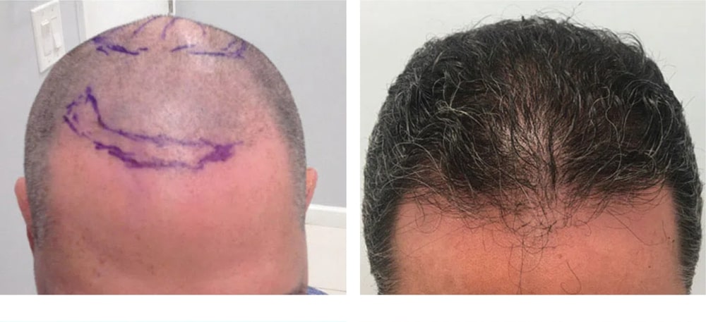 Hair Restoration Results Before and After