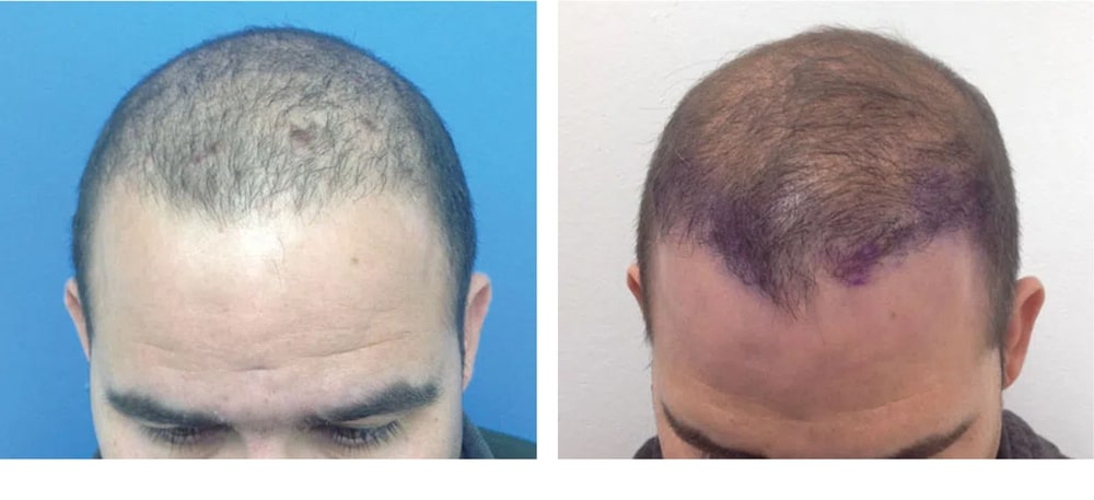 Hair Restoration Results Before and After