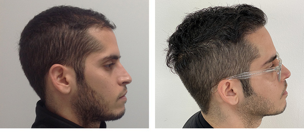 Hair Restoration Results Before and After