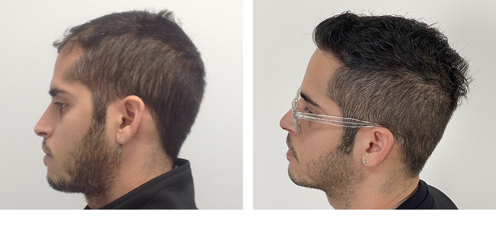 Hair Restoration Results Before and After