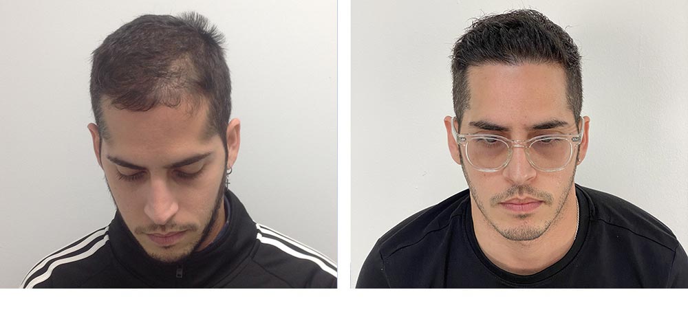 Hair Restoration Results Before and After